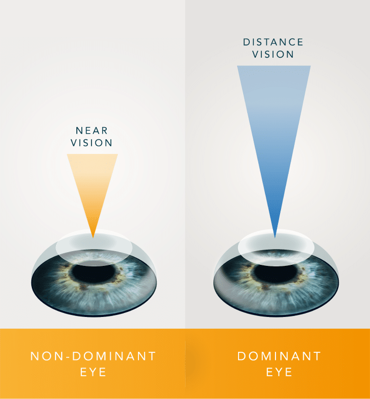monovision infographic