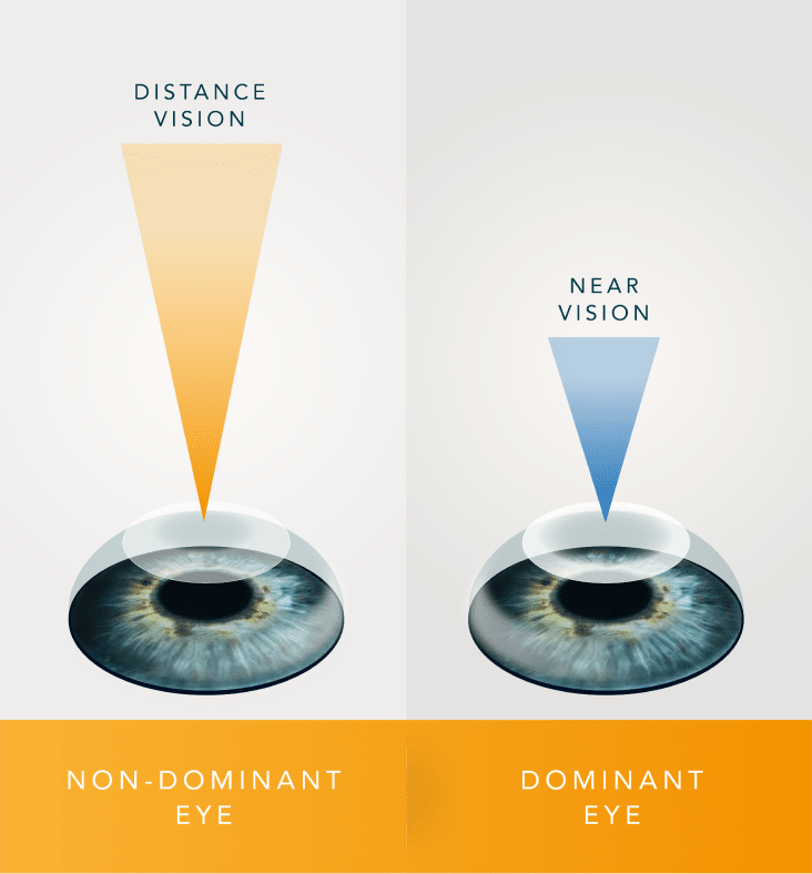 monovision infographic