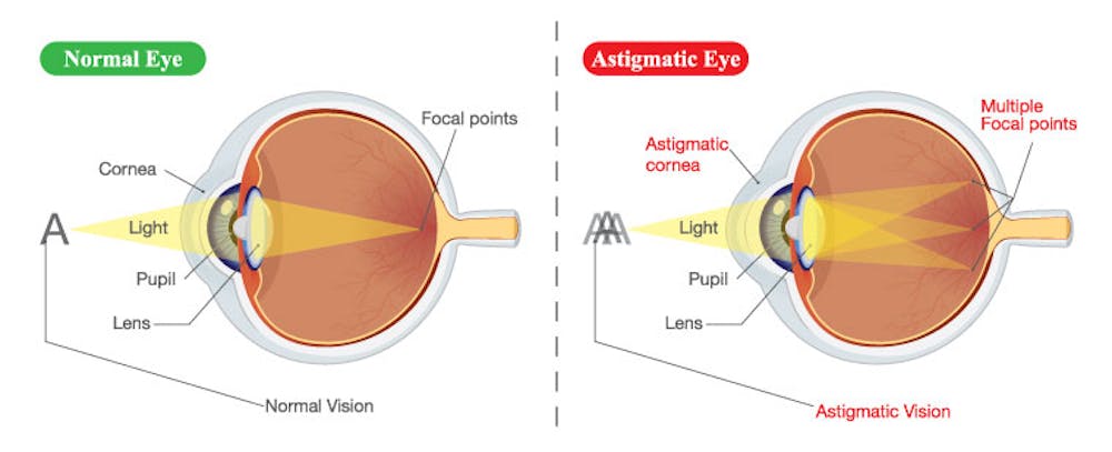 astigmatism diagram