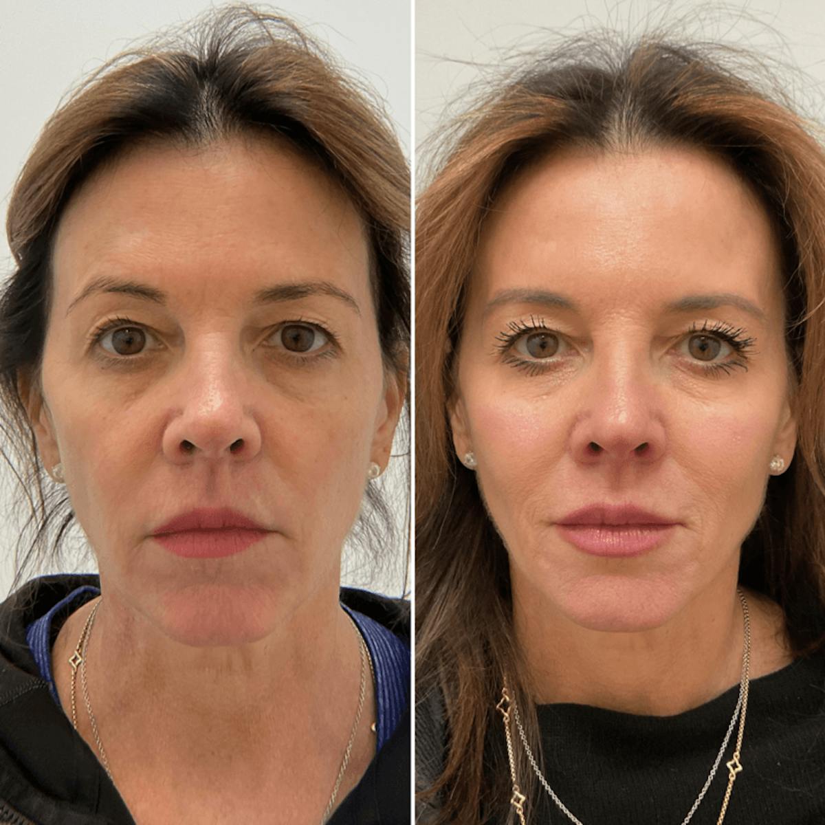 Facial Balancing Before & After Gallery - Patient 283106 - Image 1