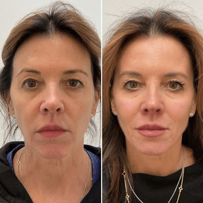 Facial Balancing - archived Before & After Gallery - Patient 283106 - Image 1