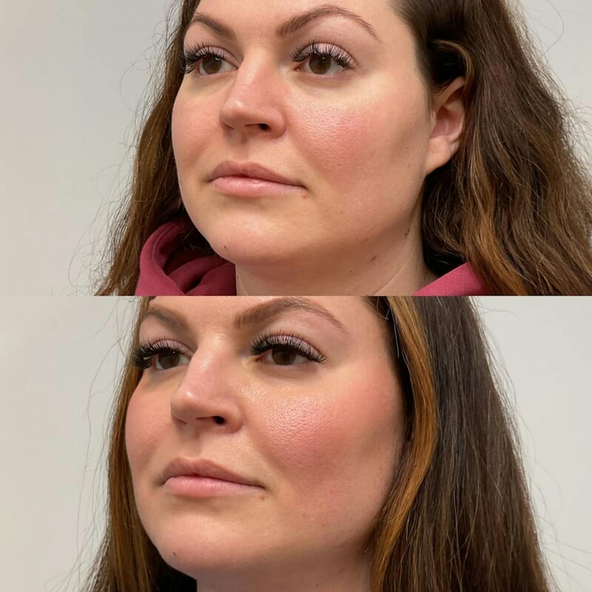 Facial Balancing Before & After Gallery - Patient 112947 - Image 1