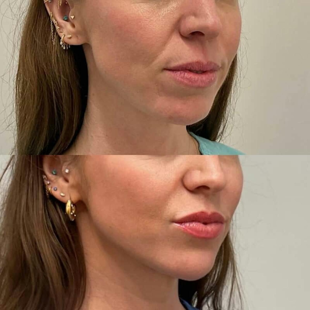 Facial Balancing Before & After Gallery - Patient 117755 - Image 1
