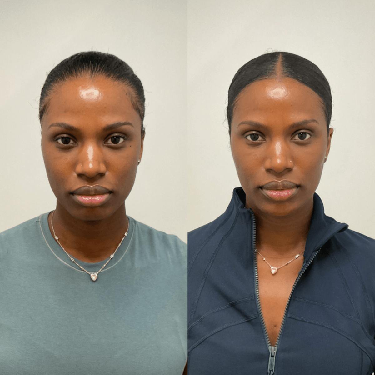 Facial Balancing Before & After Gallery - Patient 197623 - Image 1