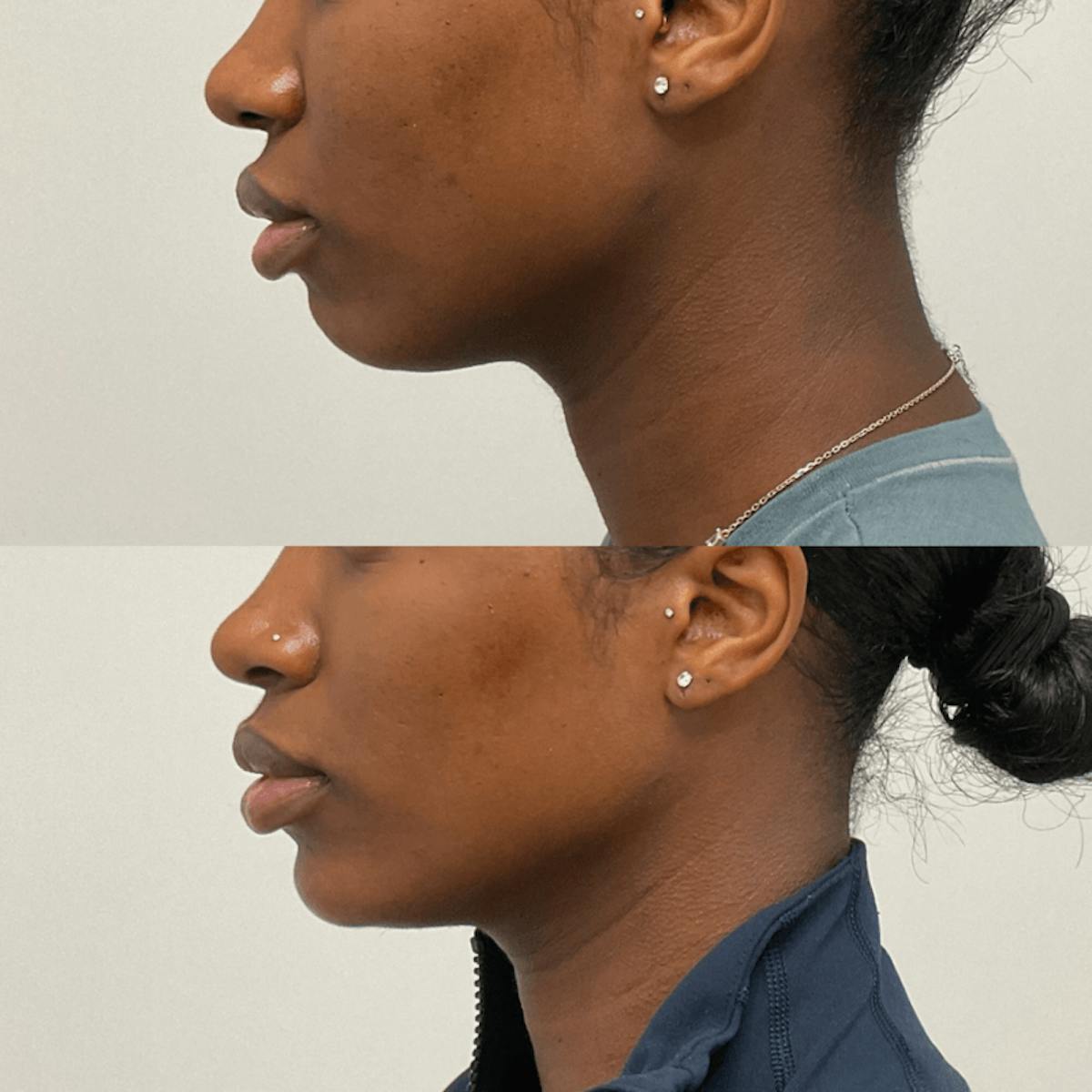 Facial Balancing Before & After Gallery - Patient 272910 - Image 1