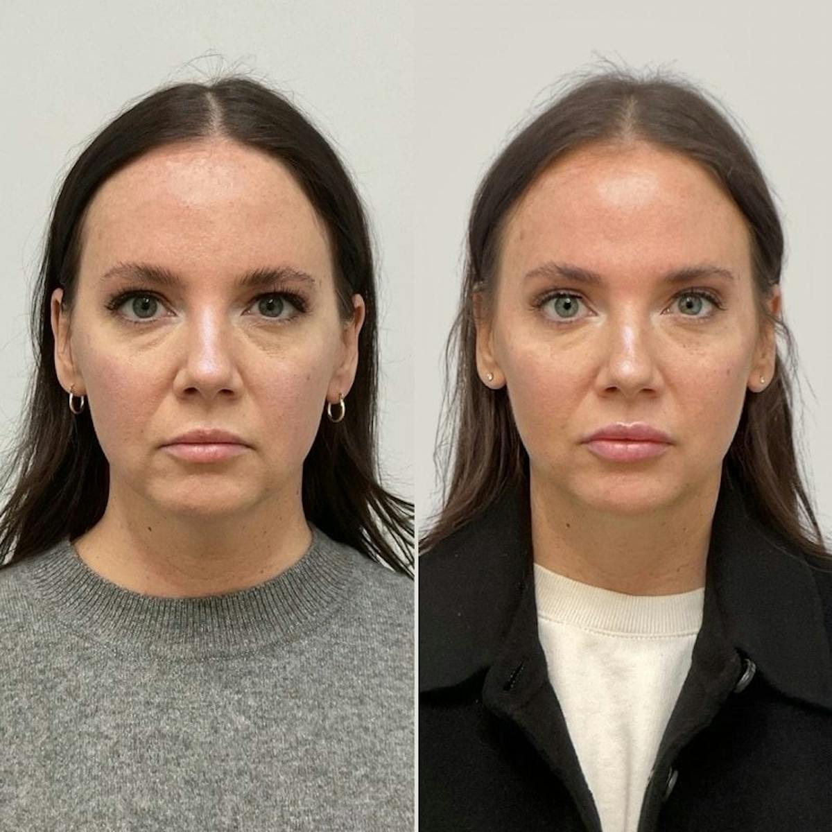 Facial Balancing Before & After Gallery - Patient 114498 - Image 1