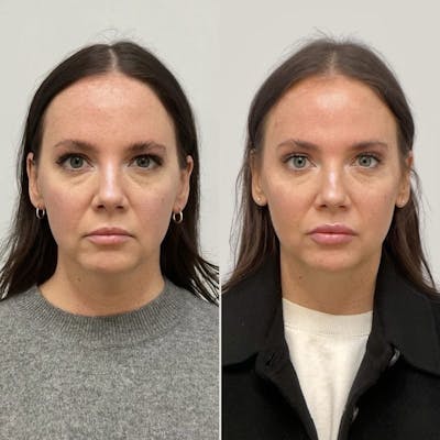 Facial Balancing - archived Before & After Gallery - Patient 114498 - Image 1