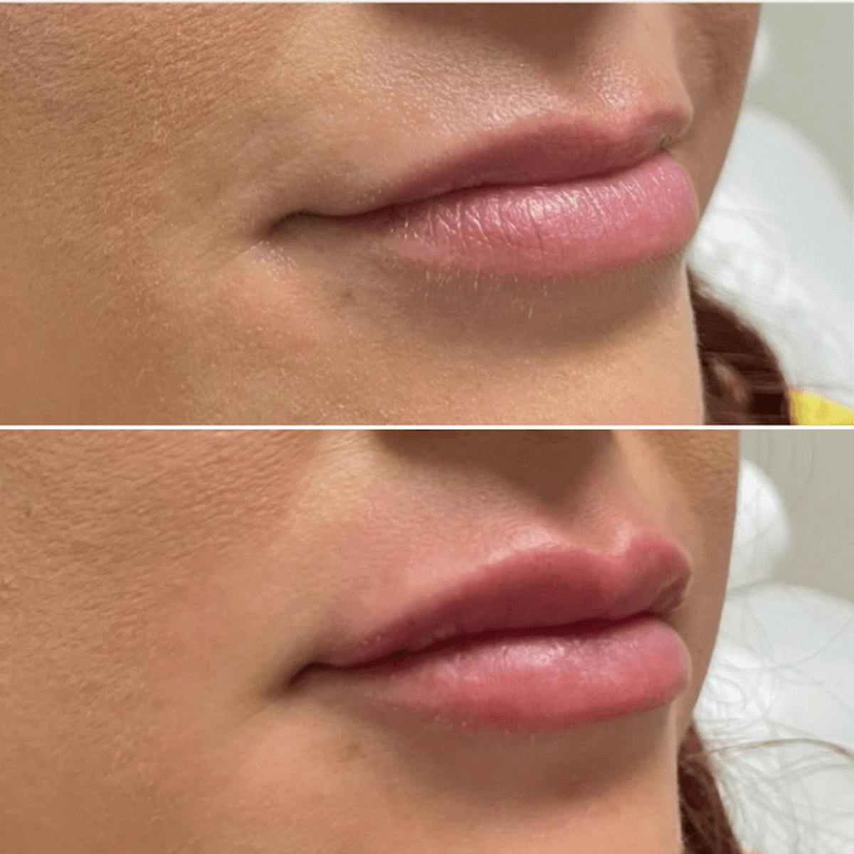 Lips Before & After Gallery - Patient 291854 - Image 1