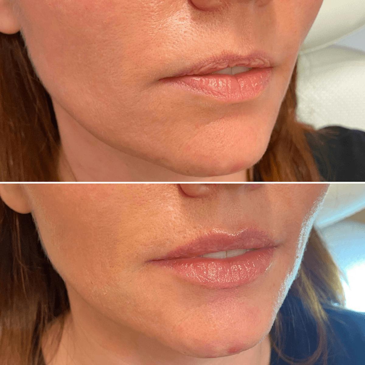 Lips Before & After Gallery - Patient 222996 - Image 1