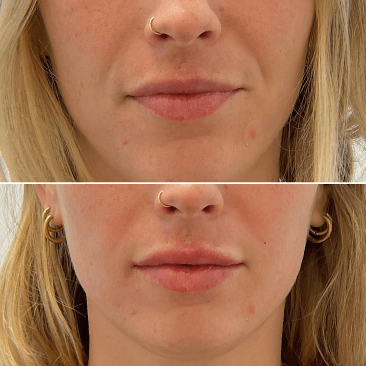 Lips Before & After Gallery - Patient 369244 - Image 1