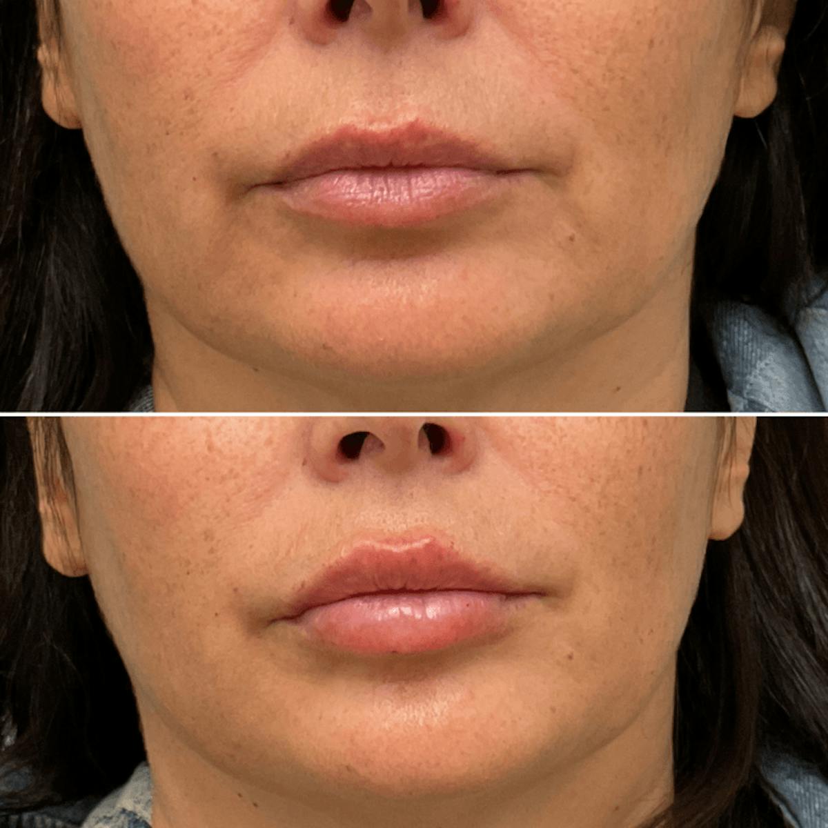 Lips Before & After Gallery - Patient 234905 - Image 1