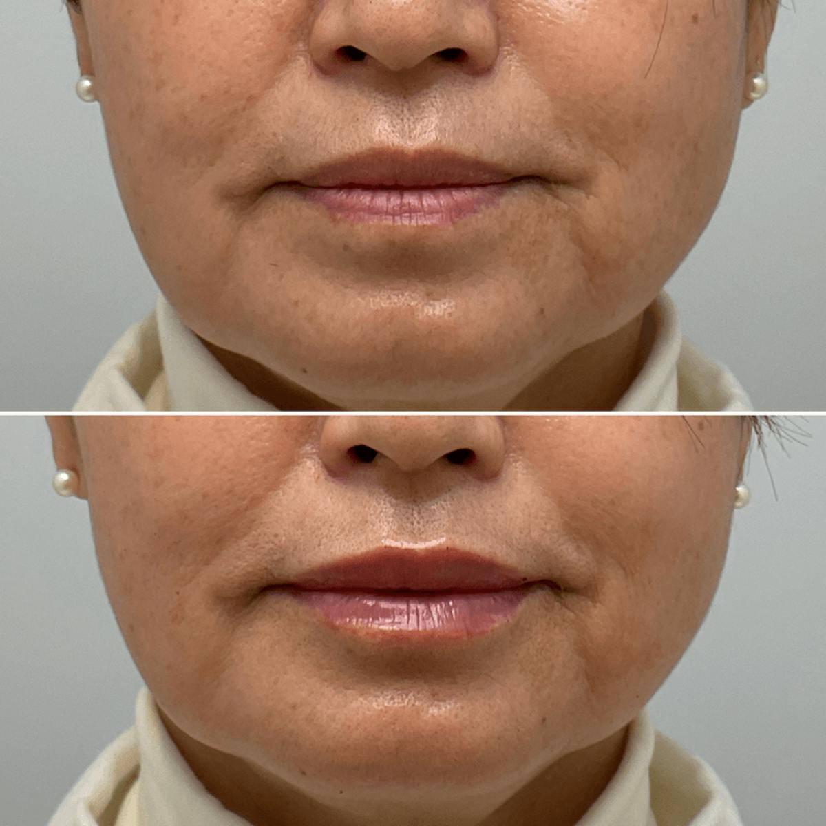 Lips Before & After Gallery - Patient 337282 - Image 1
