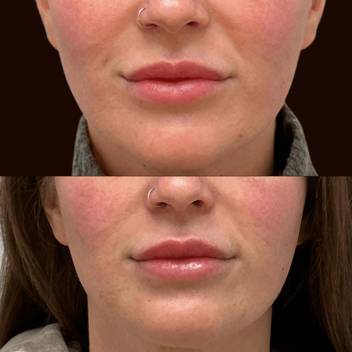 Lips Before & After Gallery - Patient 265475 - Image 1