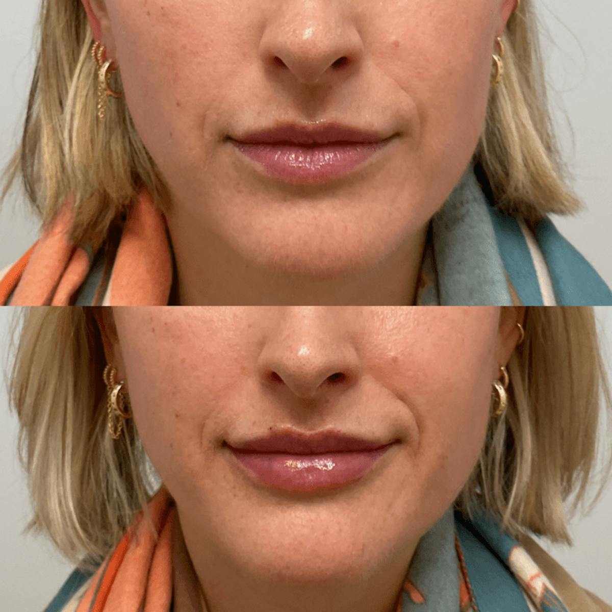 Lips Before & After Gallery - Patient 215211 - Image 1