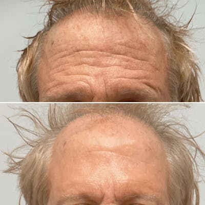 Forehead - archived Before & After Gallery - Patient 299752 - Image 1