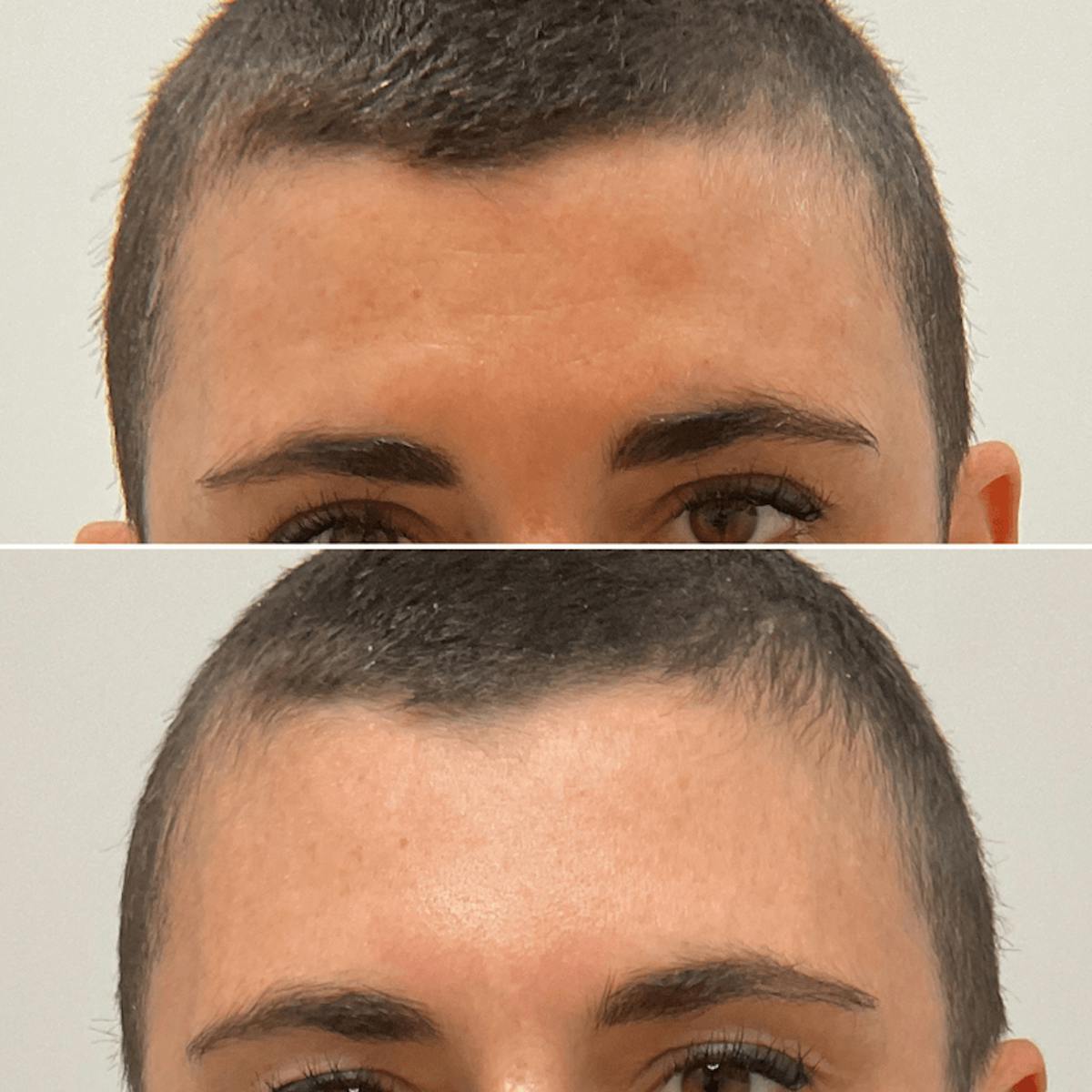 Forehead Before & After Gallery - Patient 537094 - Image 1