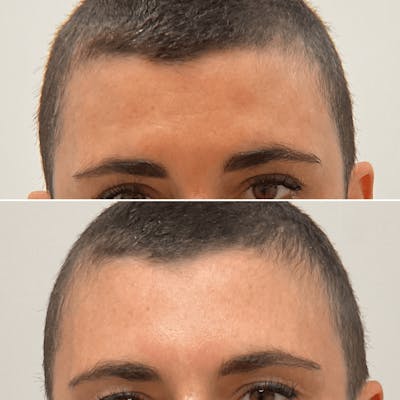 Forehead - archived Before & After Gallery - Patient 537094 - Image 1