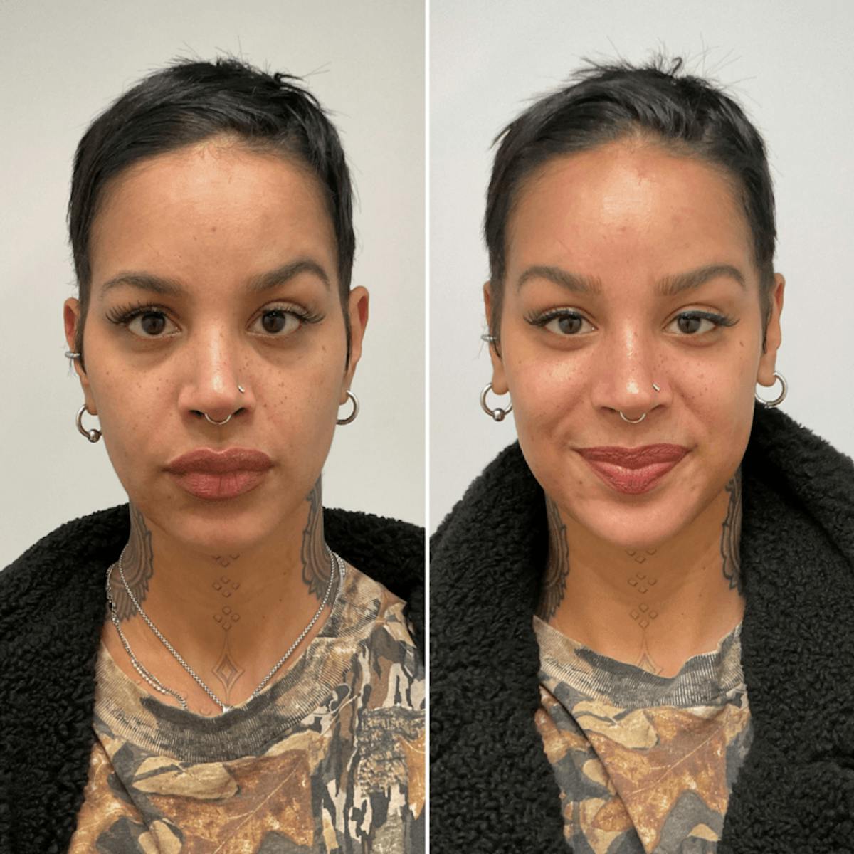 Hydrafacial Before & After Gallery - Patient 186454 - Image 1
