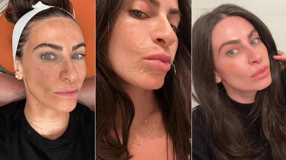 vi peel results