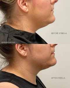 kybella results