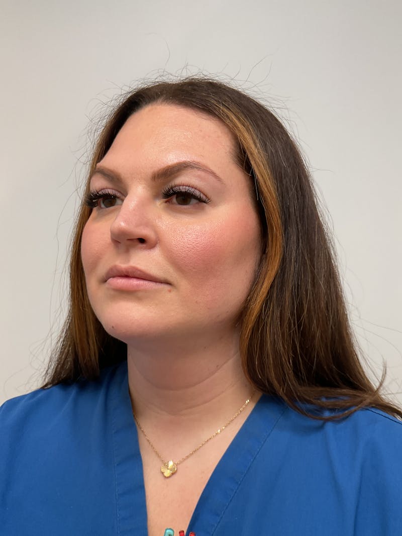 Facial Balancing Before & After Gallery - Patient 261797 - Image 1