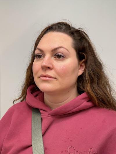 Facial Balancing Before & After Gallery - Patient 261797 - Image 2