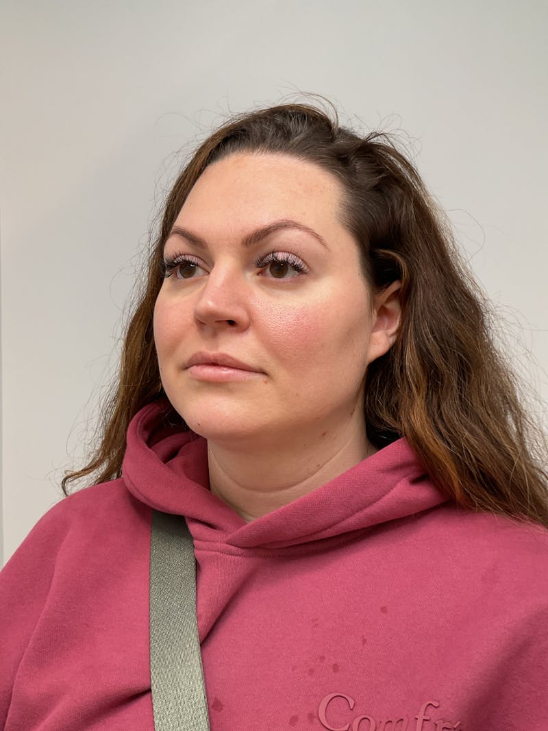 Facial Balancing Before & After Gallery - Patient 261797 - Image 2