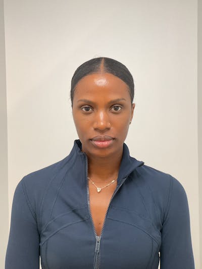 Facial Balancing Before & After Gallery - Patient 756667 - Image 1