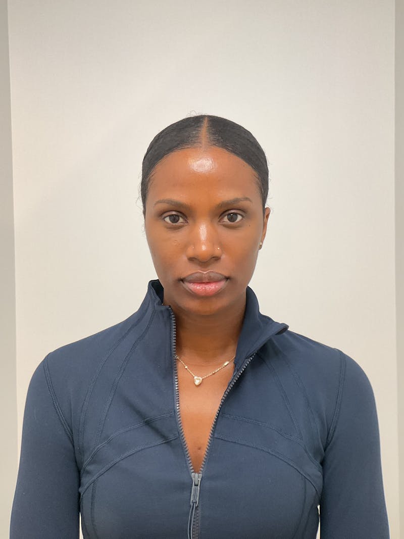 Facial Balancing Before & After Gallery - Patient 756667 - Image 1
