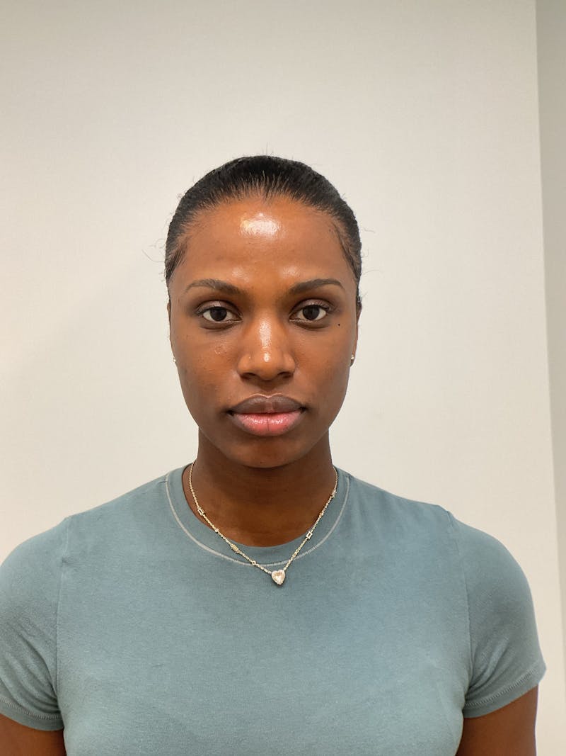 Facial Balancing Before & After Gallery - Patient 756667 - Image 2