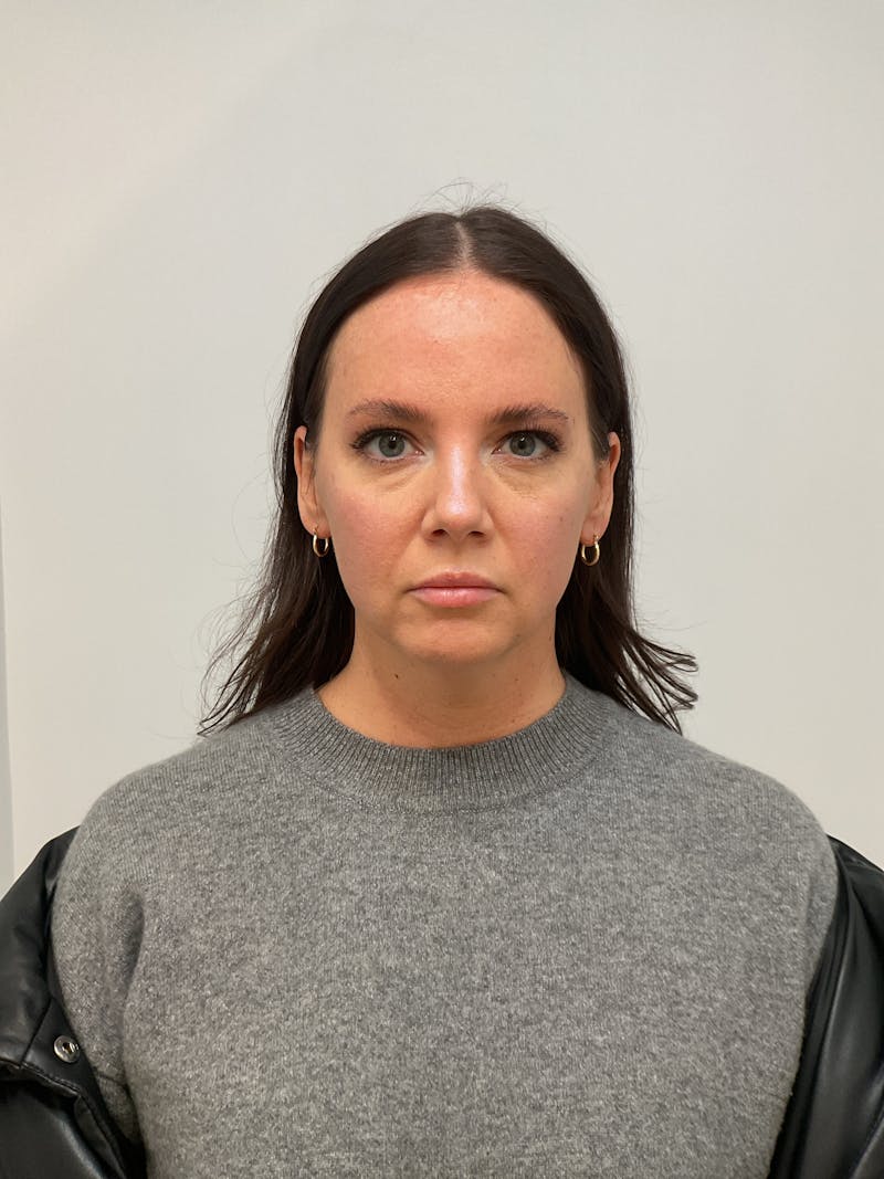 Facial Balancing Before & After Gallery - Patient 307362 - Image 1