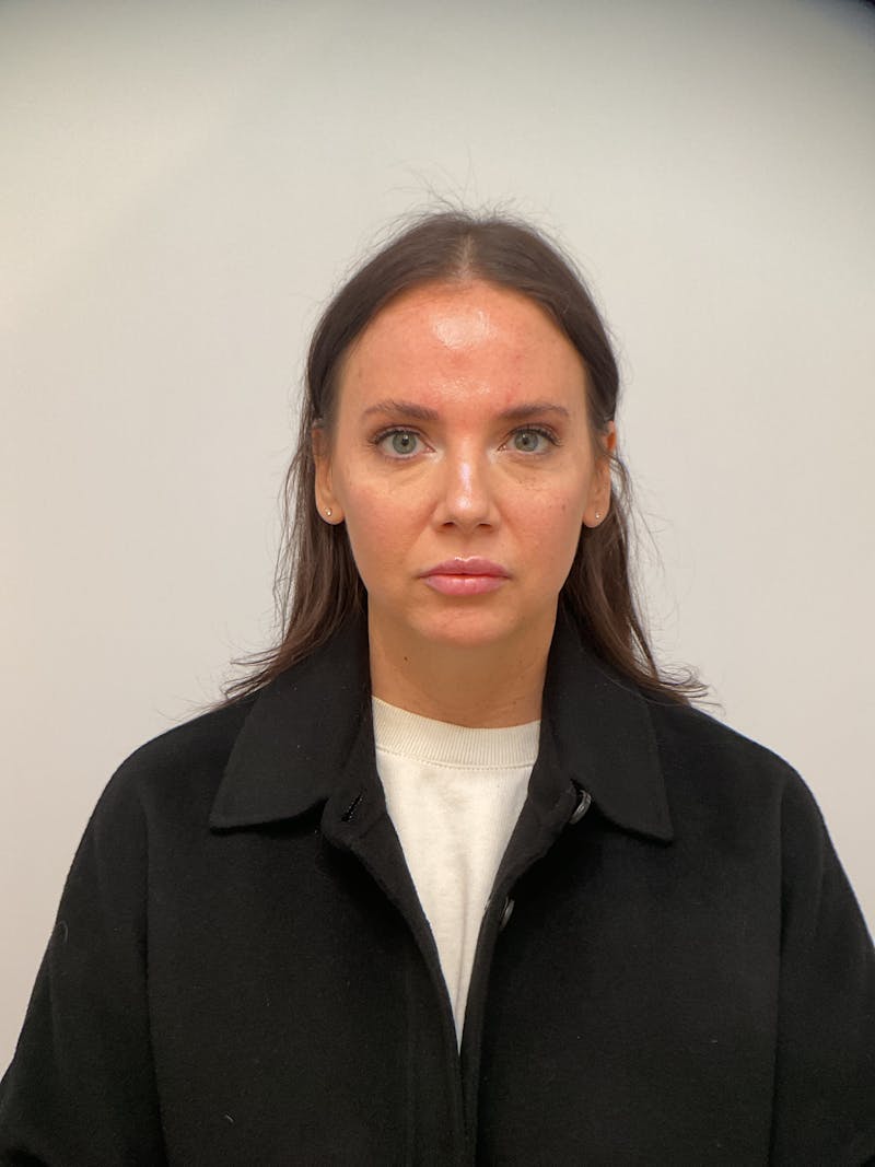 Facial Balancing Before & After Gallery - Patient 307362 - Image 2