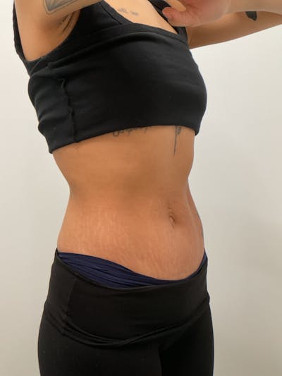 Body Before & After Gallery - Patient 120474 - Image 2