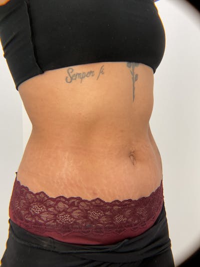 Body Before & After Gallery - Patient 120474 - Image 1