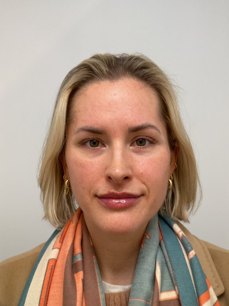 Lips Before & After Gallery - Patient 133983 - Image 2