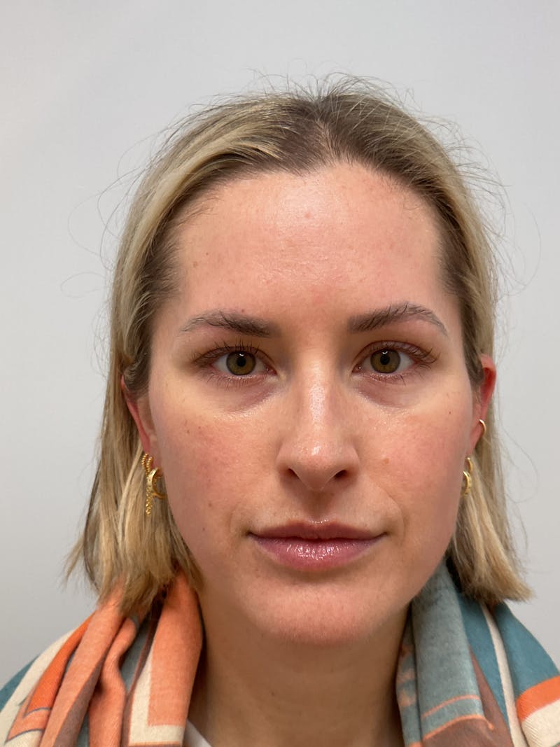 Lips Before & After Gallery - Patient 133983 - Image 1