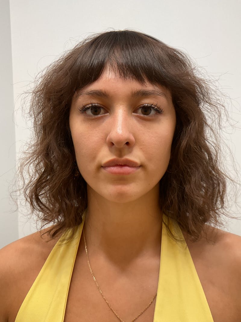 Lips Before & After Gallery - Patient 355678 - Image 1