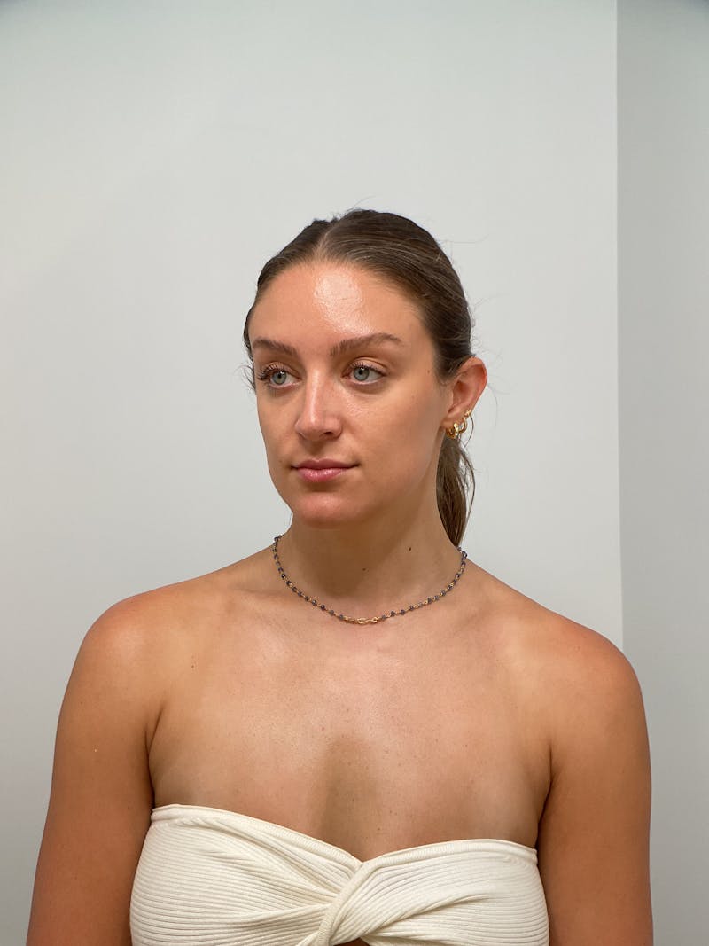 Lips Before & After Gallery - Patient 775376 - Image 1