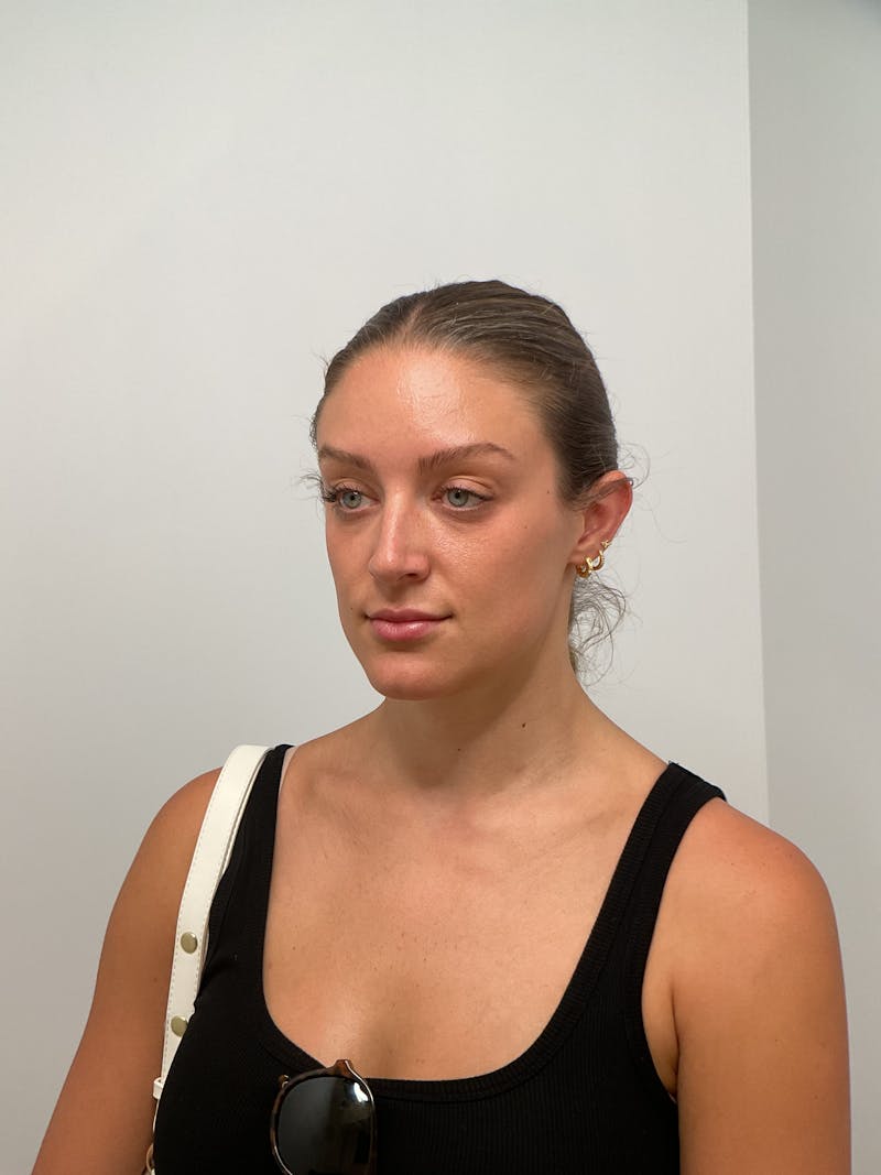 Lips Before & After Gallery - Patient 775376 - Image 2