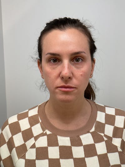 Under Eye Before & After Gallery - Patient 349068 - Image 1