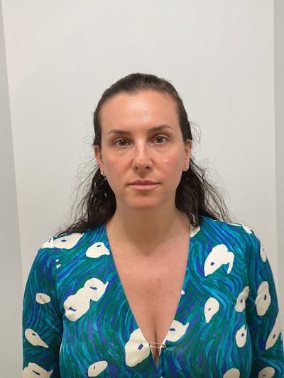 Under Eye Before & After Gallery - Patient 349068 - Image 2