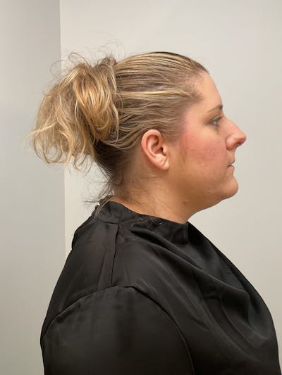 Kybella Before & After Gallery - Patient 350544 - Image 1