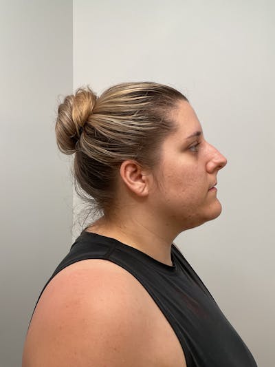 Kybella Before & After Gallery - Patient 350544 - Image 2