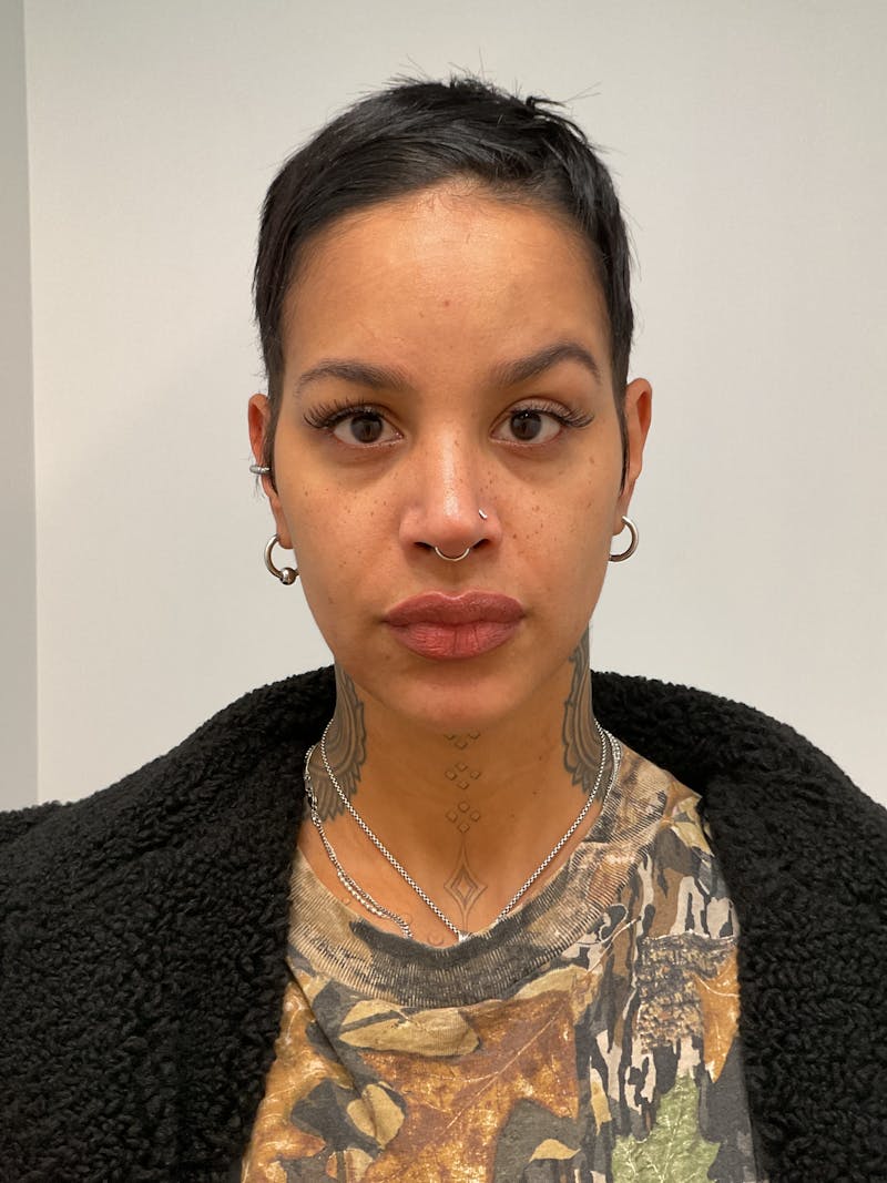 Hydrafacial Before & After Gallery - Patient 180241 - Image 1