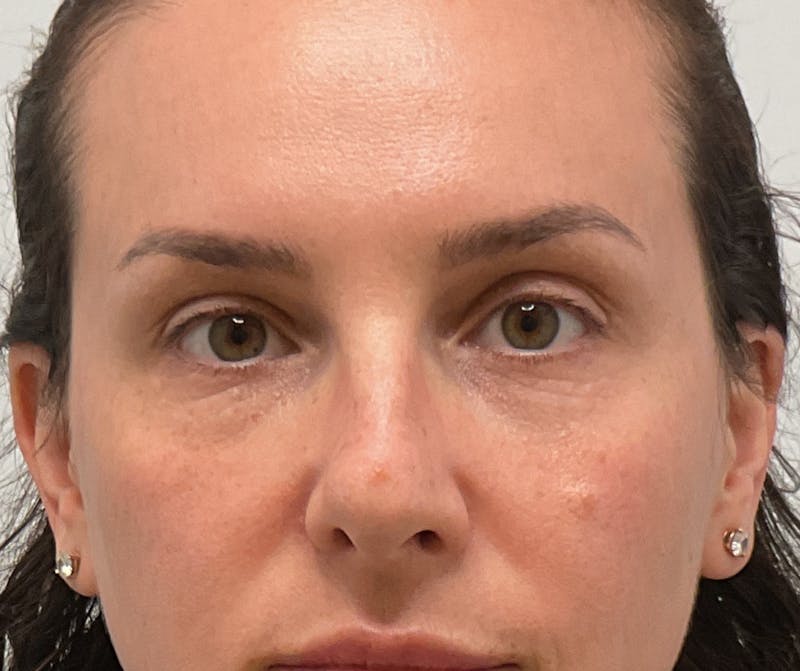 Under Eye Before & After Gallery - Patient 280361 - Image 2