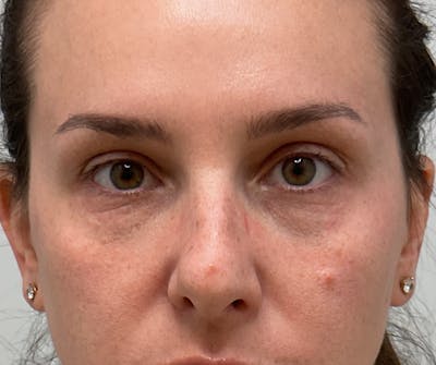 Under Eye Before & After Gallery - Patient 280361 - Image 1