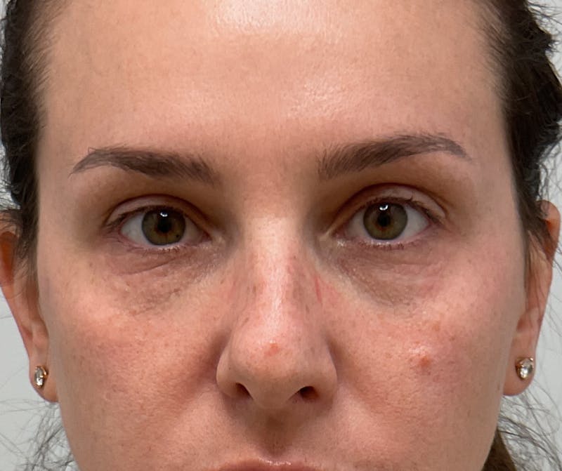 Under Eye Before & After Gallery - Patient 280361 - Image 1