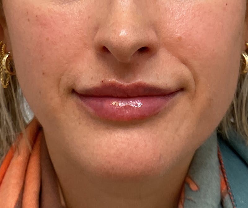 Lips Before & After Gallery - Patient 219624 - Image 2