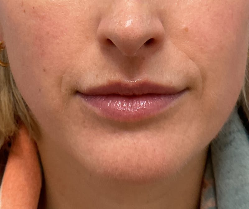 Lips Before & After Gallery - Patient 219624 - Image 1