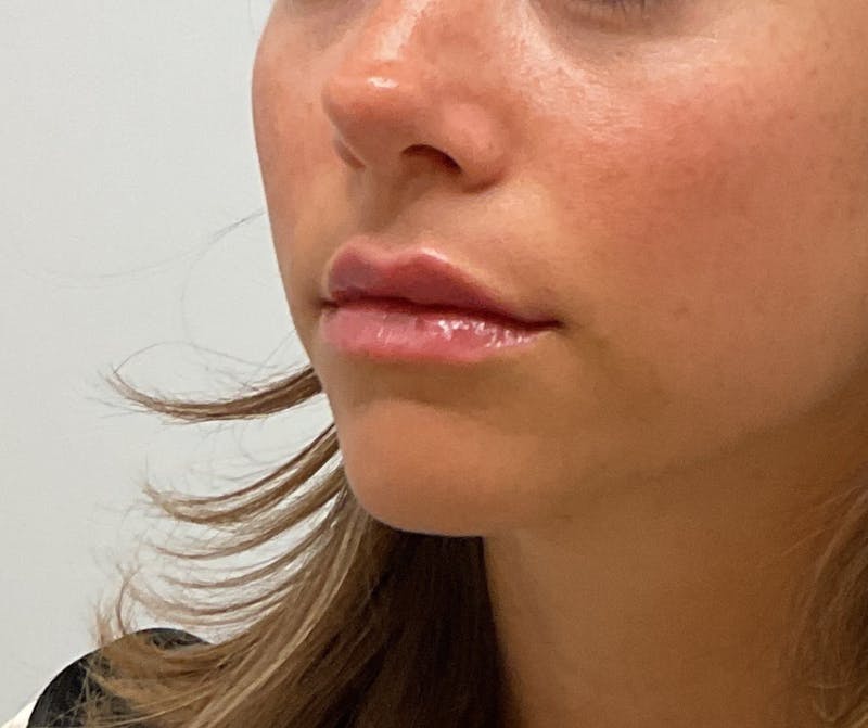 Lips Before & After Gallery - Patient 296285 - Image 2